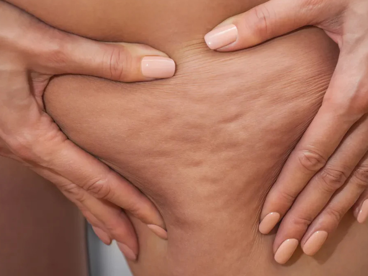 Stanchezza e pesantezza: sintomi nascosti del lipedema